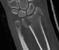 Distal Radius Radioulna Fragments